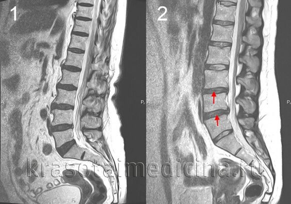 Osteohondroza hrbtenice